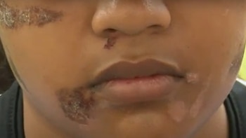 Una adolescente venezolana sufre quemaduras en el 40% de su rostro como resultado de actos de bullying en su colegio en Puente Piedra. (Captura)