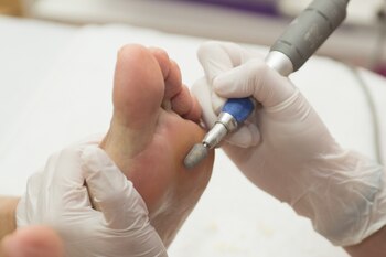 Tratamiento de podología (AdobeStock)