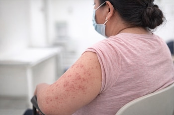 Vista trasera de una mujer adulta sentada, con mascarilla azul y camiseta rosa, mostrando una erupción cutánea roja y abultada en su brazo y codo.