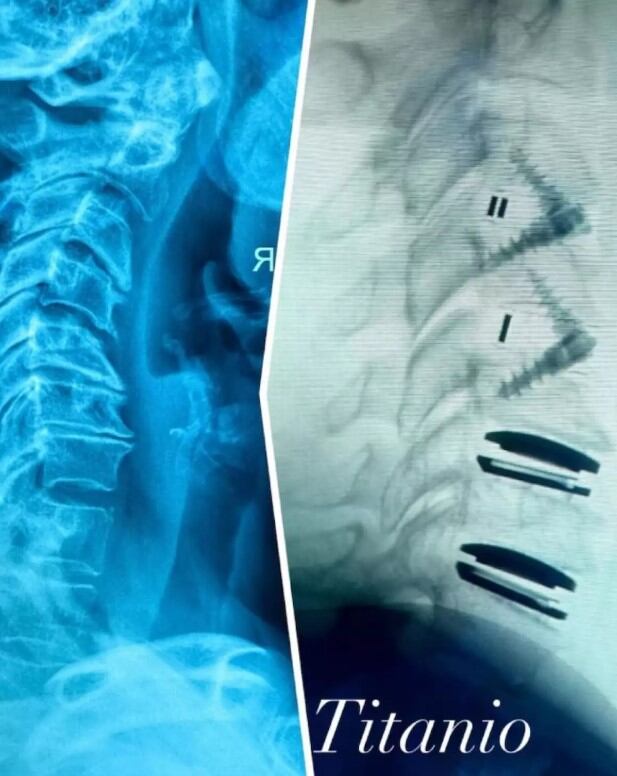 Recientemente Alejandra mostró una radiografía donde se observan las placas de titanio que le fueron colocadas en las vértebras cervicales (IG)