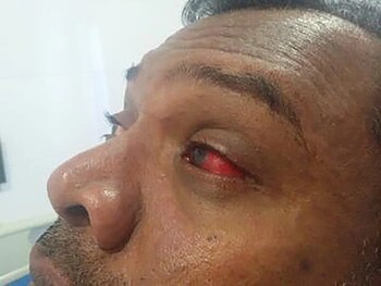 El sarampión también afecta a