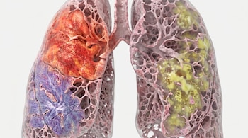 Visualización hiperrealista de un pulmón humano con áreas inflamatorias de color rojo, morado y amarillo-verde, mostrando una estructura de tejido poroso.