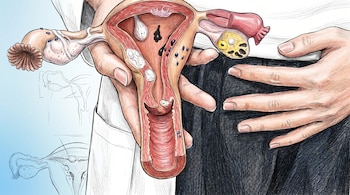 Dibujo anatómico detallado del sistema reproductivo femenino, mostrando útero, trompas y ovarios con patologías, sostenido por manos sobre fondo azul.