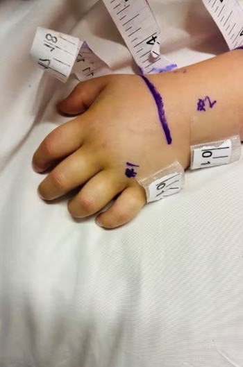 Primer plano de la mano de un niño con cinta métrica enrollada, una línea morada dibujada en el dorso y números escritos sobre la piel