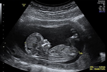 La gastrosquisis es un defecto