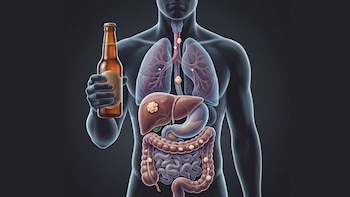 Más allá del hígado: identifican que las muertes por cáncer vinculadas al alcohol se duplicaron en 3 décadas