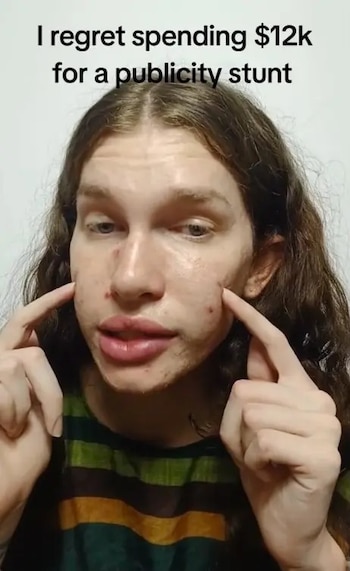 Jolene Dawson utilizó rellenos e