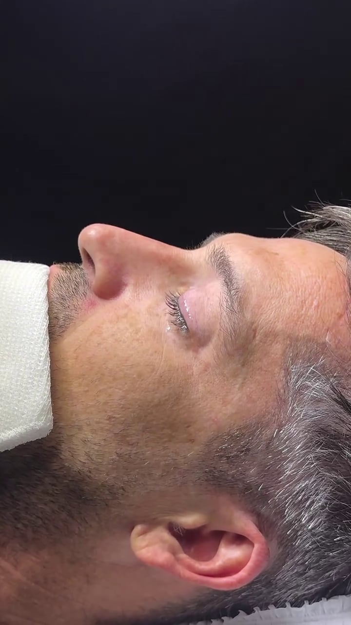 El exjugador de Gran Hermano antes de someterse a una rinoplastia