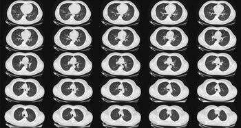 Las tomografías computarizadas, llamadas tomografías