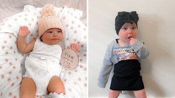 Ayla, la bebé con síndrome