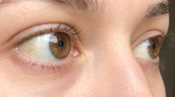 Primer plano de dos ojos de una persona, mostrando el blanco de los ojos con un tenue color amarillento y pestañas oscuras.
