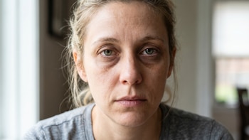 Por qué ninguna cantidad de sueño elimina las ojeras y cuáles son las claves dermatológicas sobre su origen