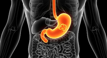 El cáncer de estómago aumenta