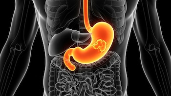 Por qué el cáncer de