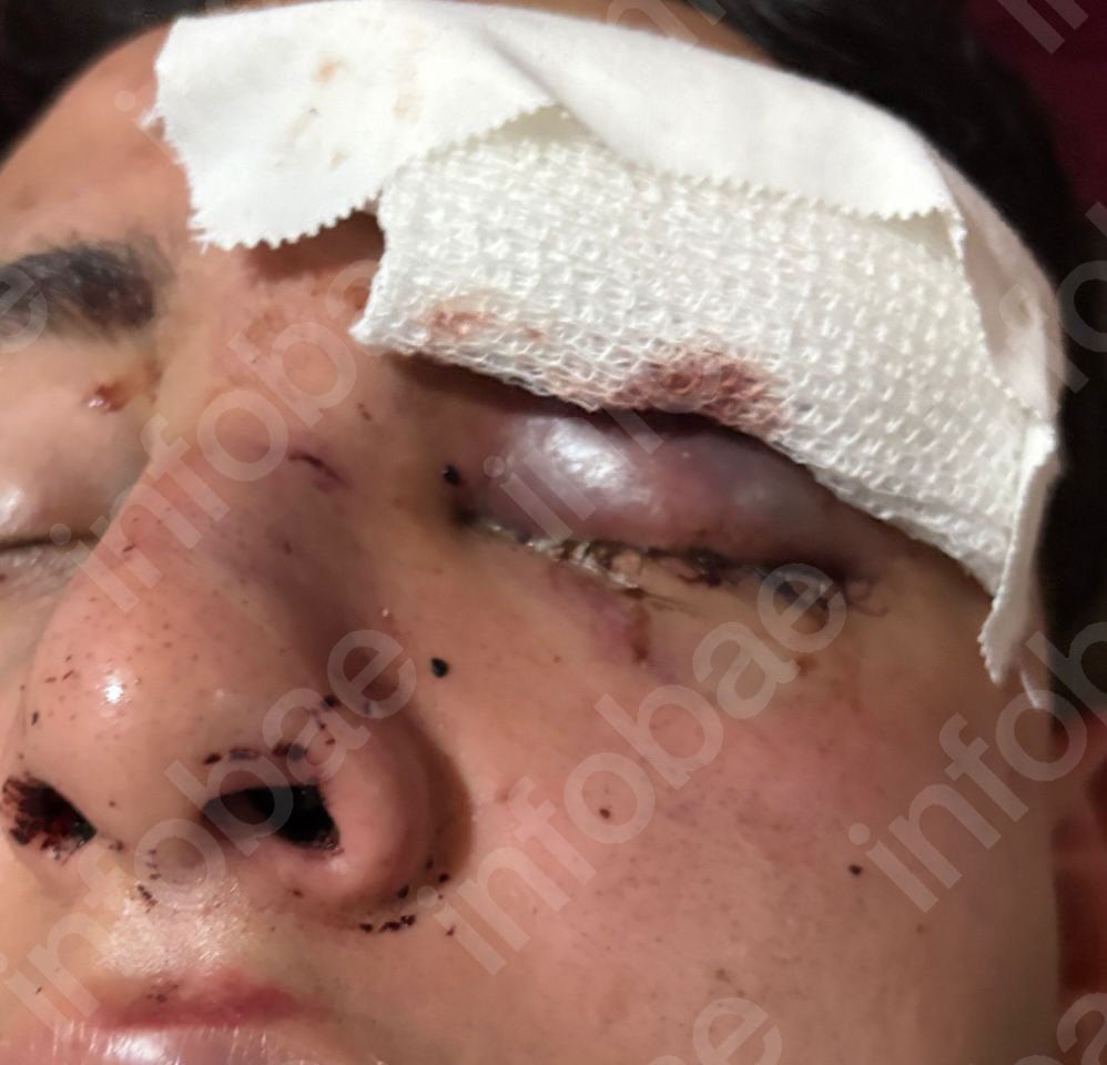 Los médicos del hospital constataron fracturas en la nariz y los pómulos, además de múltiples cortes en la cara del joven