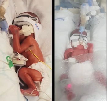 Dos bebés prematuros en cunas hospitalarias. Cada bebé tiene vendajes en la cabeza, tubos y cables. Uno de lado, otro de espalda con plástico de burbujas