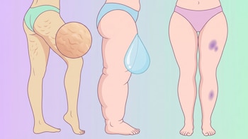 Celulitis, linfedema y lipedema: cómo identificarlas y cuándo consultar con un especialista