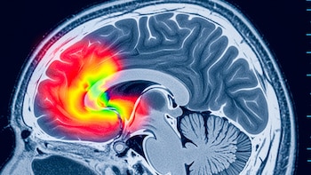 ACV transitorio: las señales silenciosas