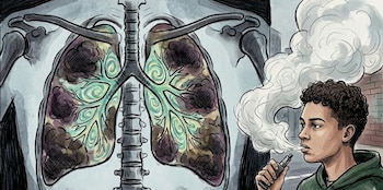 Ilustración de un joven vapeando con grandes nubes de vapor, mientras se superponen unos pulmones con manchas oscuras y tonalidades verdosas