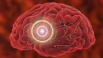 Las tasas de accidente vascular cerebral casi se duplican en adultos jóvenes