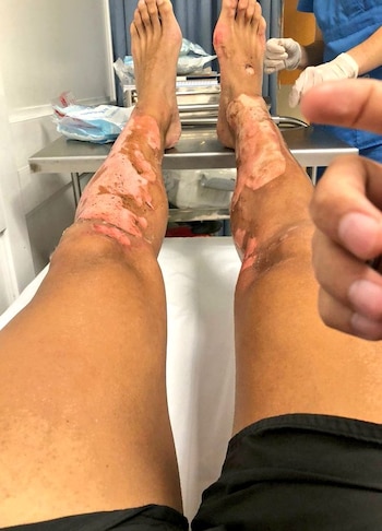 Las piernas quemadas de Mathías