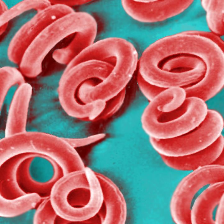 Los síntomas de la enfermedad pueden demorar varias semanas en aparecer tras la ingesta