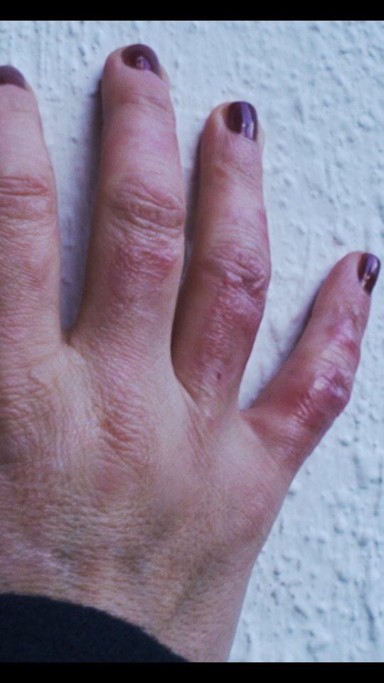 La mano de María Julia Oliván con las quemaduras que sufrió por el incendio en su casa