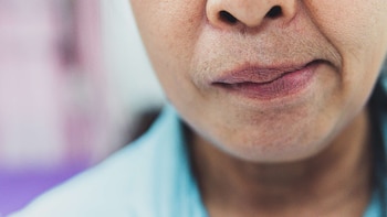 Parálisis facial: síntomas que aparecen