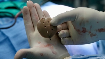 Costa Rica marca un hito médico: implanta por primera vez una prótesis craneal fabricada con impresión 3D por su sistema público de salud