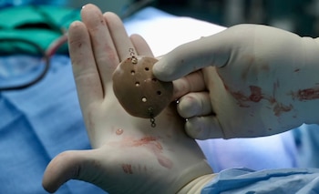 El dispositivo fue producido con PEEK, un material ligero y resistente que además permite realizar tomografías y resonancias sin las alteraciones que pueden producir algunos implantes metálicos. Crédito: CCSS