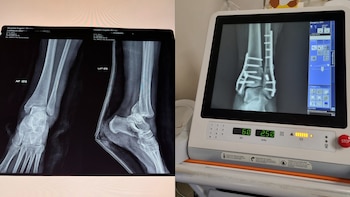 A mulher disse que sua tíbia, fíbula e calcâneo estavam quebrados. | X- @Itzamaraczav