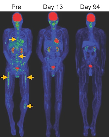 Tres escáneres PET de cuerpo completo muestran una figura humana con áreas rojas y verdes que disminuyen de "Pre" a "Día 94", sobre fondo negro