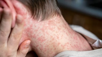 El Salvador: Salud detecta casos de sarampión, conoce sus síntomas y cómo protegerte