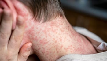 El Ministerio de Salud de El Salvador reporta once casos importados de sarampión. (Cortesía: Freepik)