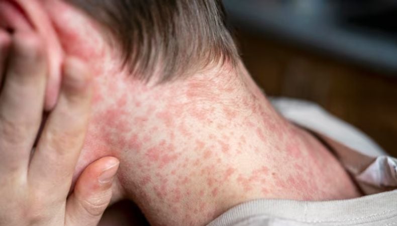 El Ministerio de Salud de El Salvador reporta once casos importados de sarampión. (Cortesía: Freepik)