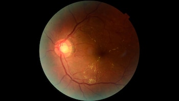 Una herramienta de IA creada por científicos argentinos identifica daños en la retina causados por diabetes antes de que aparezcan los síntomas