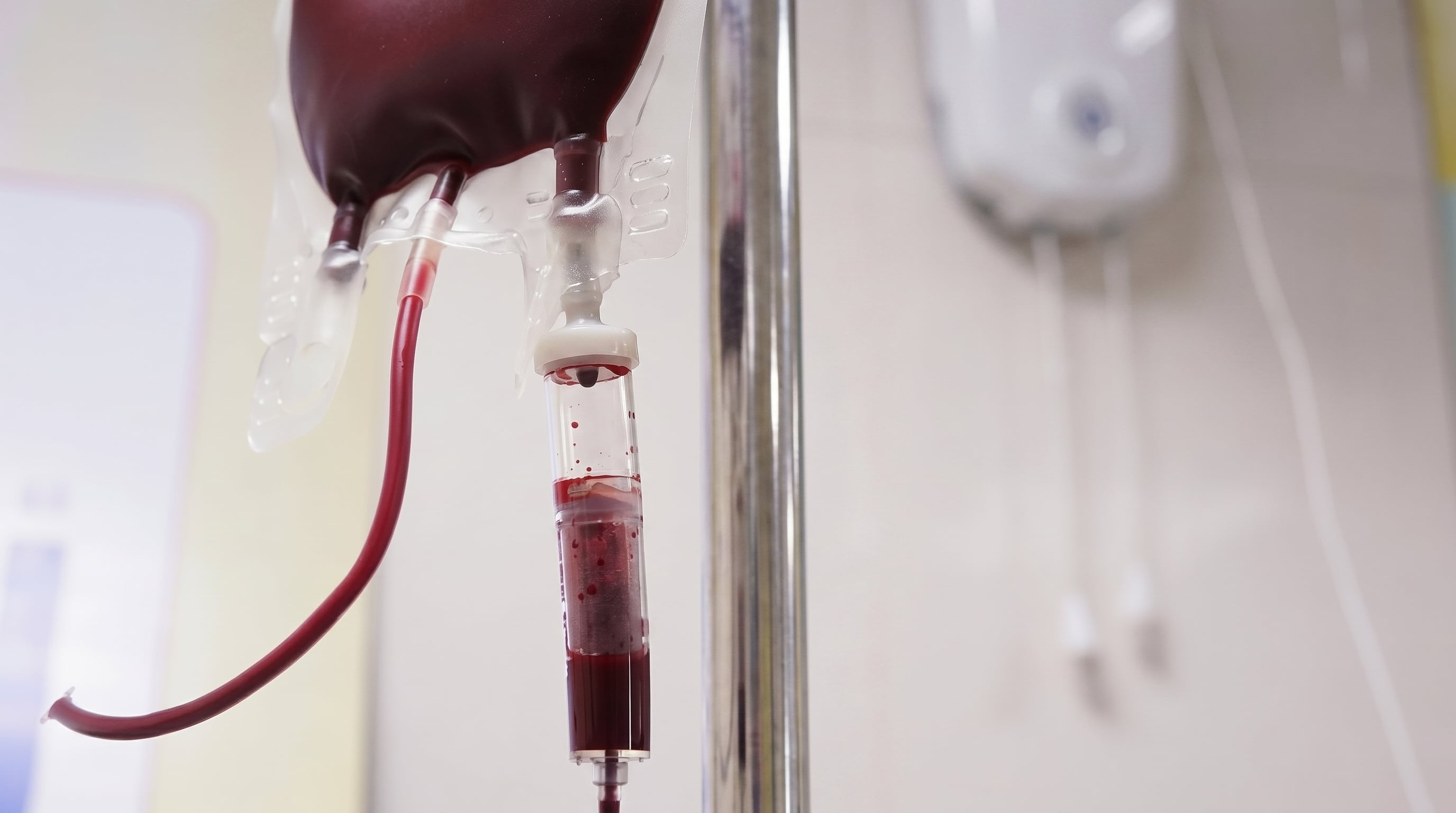 El estudio sobre químicos eternos y colesterol mostró cambios agudos tras el procedimiento, pero no demostró una eliminación completa de contaminantes ni un beneficio clínico duradero (Imagen Ilustrativa Infobae)