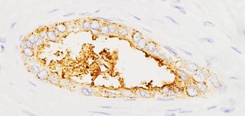 Expresión de la proteína sAXL en tumores pancreáticos. / IIBB-CSIC