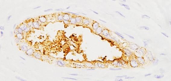 Expresión de la proteína sAXL en tumores pancreáticos. / IIBB-CSIC