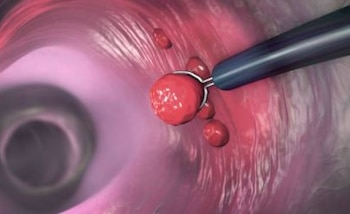 El cribado temprano y la concienciación sobre sÃntomas son cruciales para reducir los retrasos en el diagnóstico de cáncer colorrectal