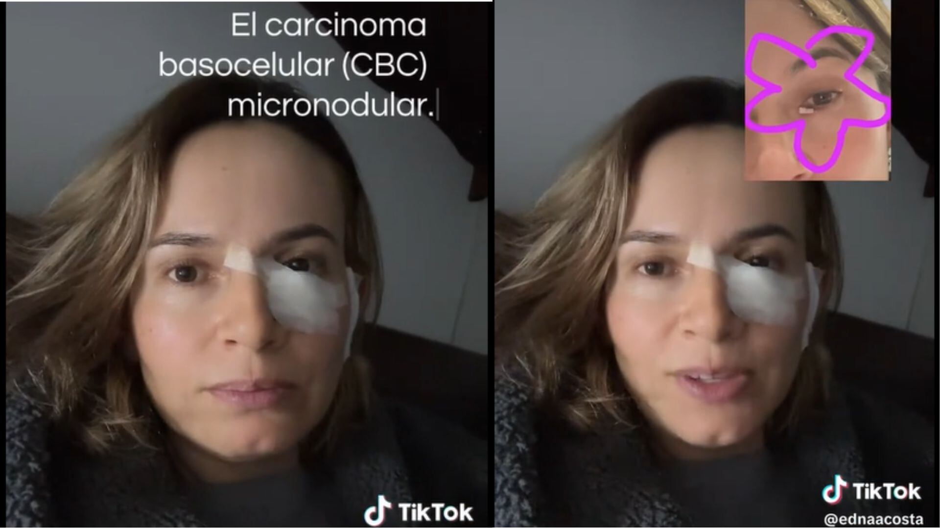 Tras notar el crecimiento anormal de una mancha bajo el ojo, la colombiana acudió al dermatólogo y recibió el diagnóstico de cáncer de piel - crédito composición fotográfica