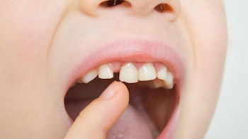 Una actuación adecuada ante un traumatismo dental en verano puede reducir el riesgo de daños permanentes, según experta