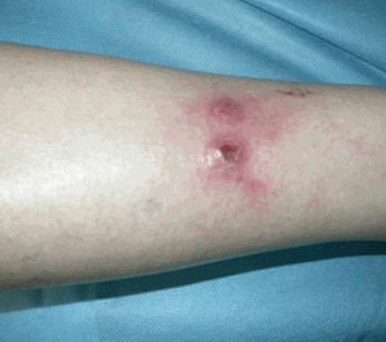 La leishmaniasis llegó a 1,822 casos acumulados en el país, con 31 registros durante la semana 35 frente a 25 contabilizados en la anterior. (Imagen de cortesía)
