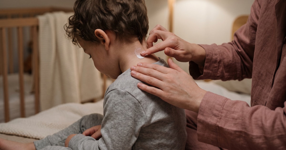 Barreras económicas impactan el tratamiento de la dermatitis atópica en Argentina