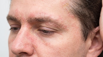 Primer plano del rostro de un hombre con piel enrojecida y escamas amarillentas en la frente, cejas, nariz y sienes. Su mano izquierda toca la cabeza.