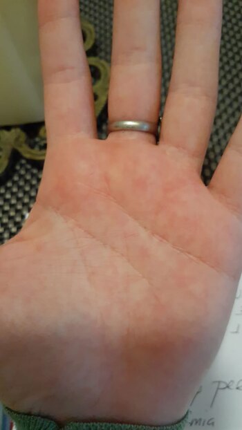 Pensé que tenía covid y me había picado el dengue