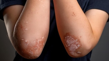 Psoriasis vinculada a la alteración de algunos dominios del sueño