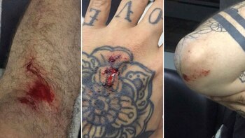 Las lesiones que sufrió Yaco