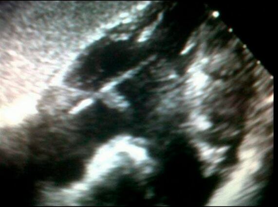 En las placas que le hacían los médicos veían como “una flecha” en el corazón. Al principio sospecharon que podía ser un catéter. Luego entendieron: los rayos x atraviesan la madera