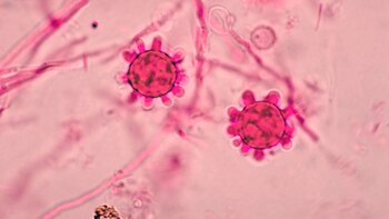 La variedad más grave de